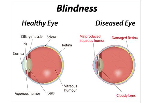 失明医療に見えてきた光――人工網膜